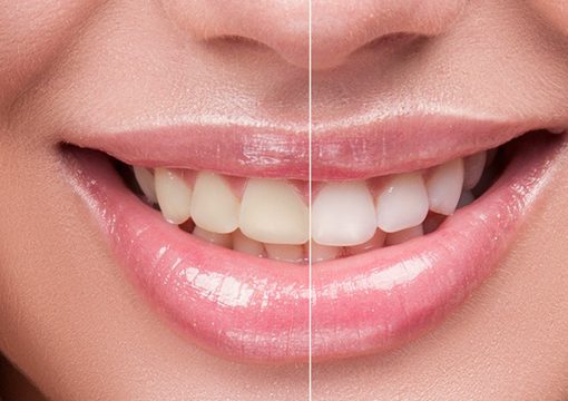 Clareamento dental